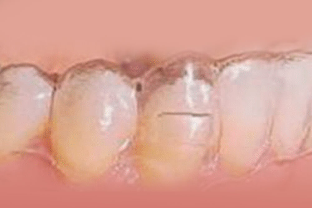 Dental close-up showing tooth enamel erosion and discoloration on upper front teeth.