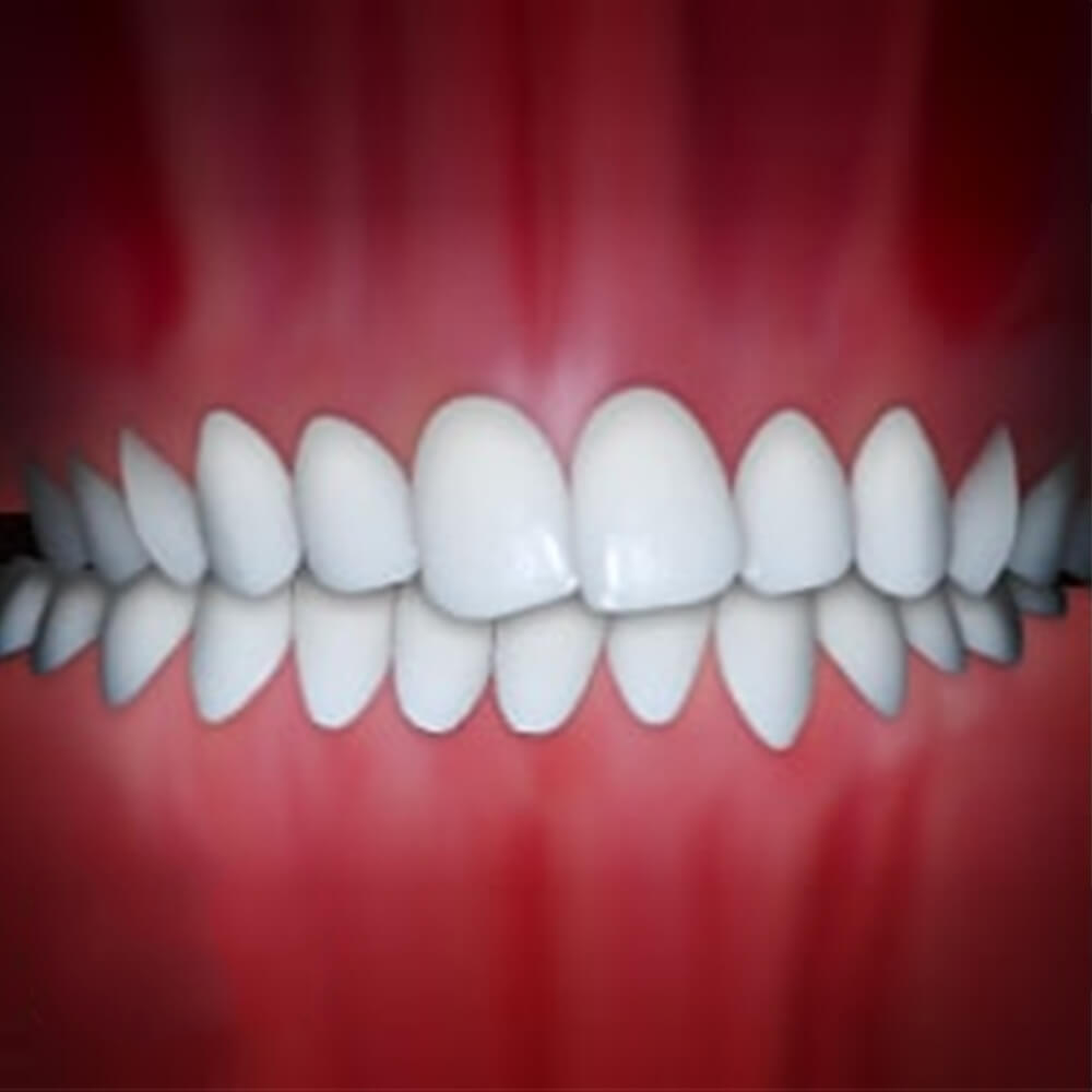 Perfect white teeth alignment shown in frontal view against red gum background.