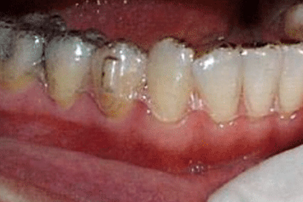 Close-up of upper front teeth showing discoloration and spacing issues before orthodontic treatment.