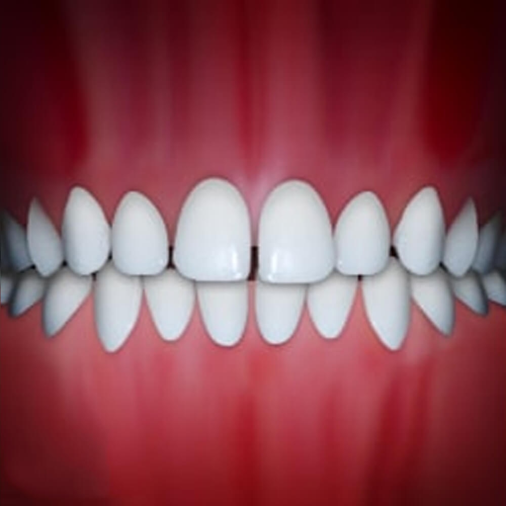 Perfectly aligned white teeth displayed against red gum background in dental illustration.