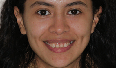 Young woman smiling at camera, displaying teeth after orthodontic treatment results.