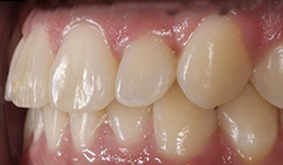 Close-up of upper front teeth showing dental alignment and tooth color variation before orthodontic treatment.