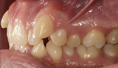 Close-up intraoral view of upper teeth showing dental crowns and orthodontic treatment progress.