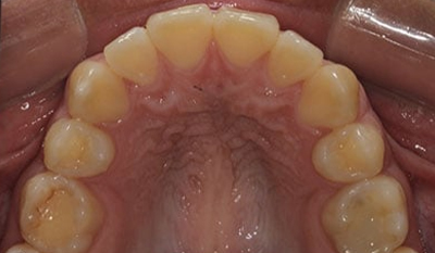 Intraoral view of upper dental arch showing teeth alignment during orthodontic treatment.