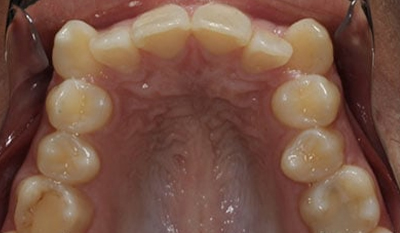 Intraoral view of upper dental arch showing natural teeth alignment and palate structure.