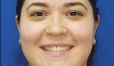 Woman smiling at camera against blue background, orthodontic before or after photo.