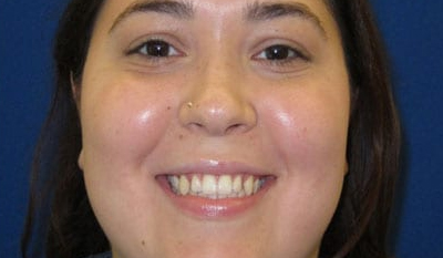 Woman smiling at camera against blue background, displaying orthodontic results.