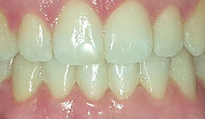 Close-up view of upper and lower teeth showing dental alignment and whiteness for orthodontic treatment.