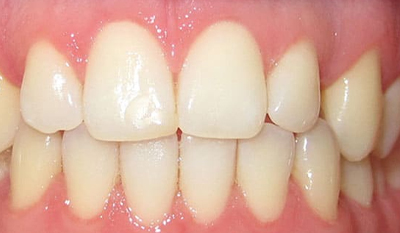 Close-up of upper and lower teeth showing dental alignment and whiteness after orthodontic treatment.