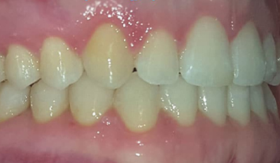 Close-up dental photograph showing upper teeth with varying shades and slight misalignment before orthodontic treatment.
