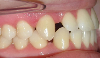 Close-up of teeth showing gaps and misalignment before orthodontic treatment.