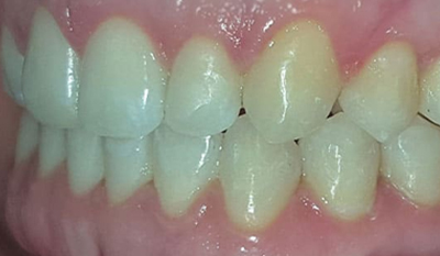 Close-up of upper and lower front teeth showing dental alignment and tooth color variation before orthodontic treatment.