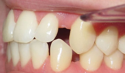 Dental closeup showing missing upper tooth with adjacent teeth and gum tissue visible.