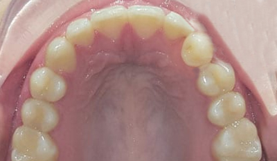 Intraoral view of upper dental arch showing teeth alignment during orthodontic treatment
