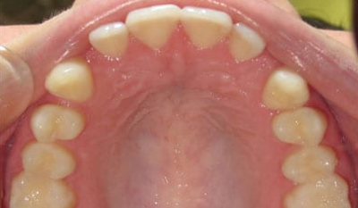 Intraoral view of upper dental arch showing tooth alignment and palate during orthodontic examination.