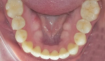 Close-up intraoral view of lower teeth showing dental alignment and bite relationship.