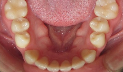 Intraoral view of lower teeth and gums showing dental alignment and bite assessment.