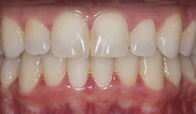 Close-up of upper and lower teeth showing straight alignment and healthy gums after orthodontic treatment.
