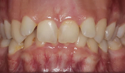 Close-up view of upper and lower teeth showing dental alignment and bite relationship in clinical setting.