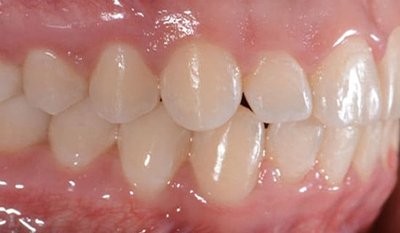 Close-up intraoral view of upper teeth showing dental alignment and gum health during orthodontic assessment.