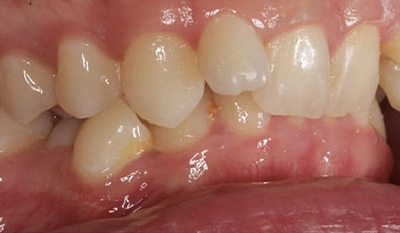 Close-up of natural teeth and pink gum tissue showing dental health and oral anatomy.