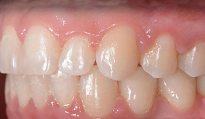 Close-up of upper and lower teeth showing dental alignment and tooth color variation in clinical setting.