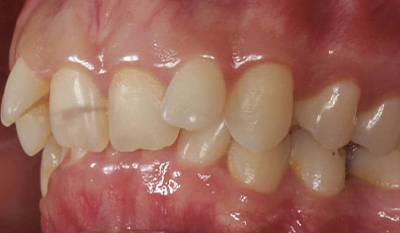 Close-up view of upper teeth showing mild crowding and misalignment before orthodontic treatment.