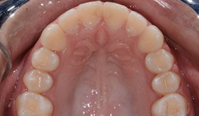 Intraoral view of upper dental arch showing teeth alignment during orthodontic treatment.