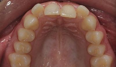 Intraoral view of upper dental arch showing teeth alignment and spacing before orthodontic treatment.
