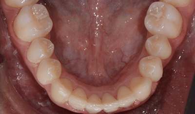 Lower dental arch view showing teeth alignment and bite relationship during orthodontic examination.