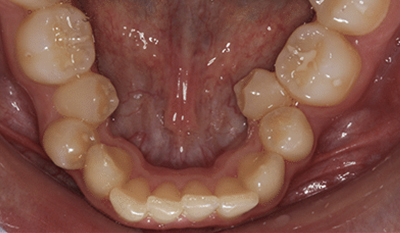 Intraoral view of lower teeth showing dental alignment and bite assessment during orthodontic examination.