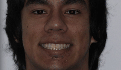 Young man smiling at camera, orthodontic before treatment photo for dental practice.