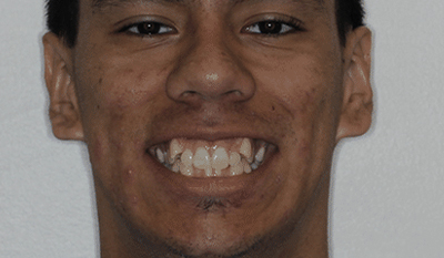 Man smiling broadly displaying teeth before orthodontic treatment in clinical setting.
