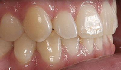 Close-up view of upper front teeth showing dental crowns and restorations on natural gum tissue.