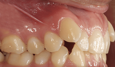 Close-up of teeth showing dental alignment and bite correction during orthodontic treatment.