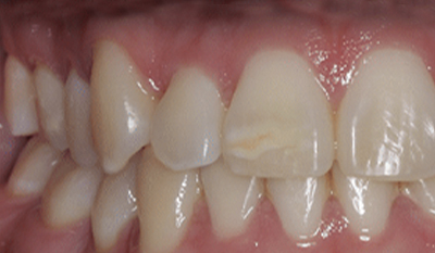 Close-up dental view showing upper front teeth with visible gaps and misalignment before orthodontic treatment.