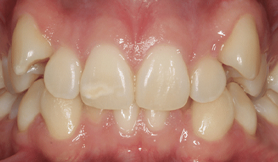 Close-up view of upper front teeth showing dental alignment and whiteness before orthodontic treatment.
