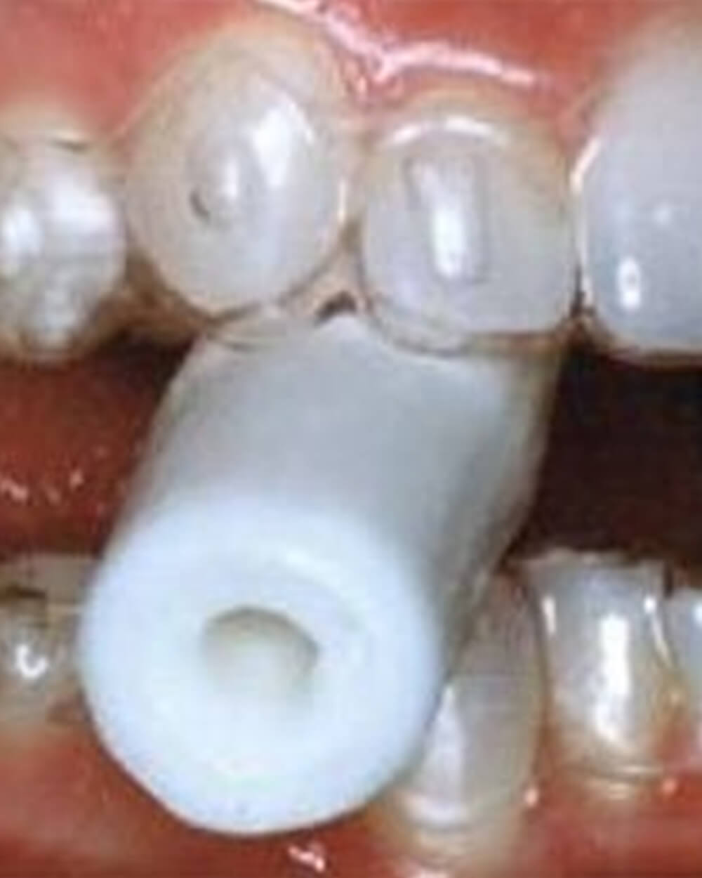 Dental implant abutment positioned among natural teeth during orthodontic treatment procedure