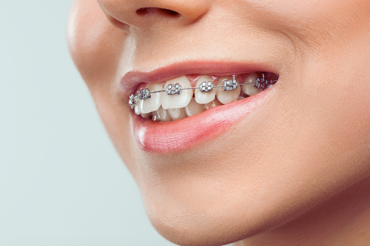 Adult Braces in West Palm Beach