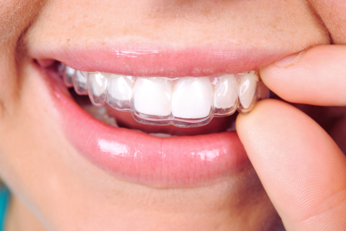 Adult Retainers guide by McCaffrey Orthodontics