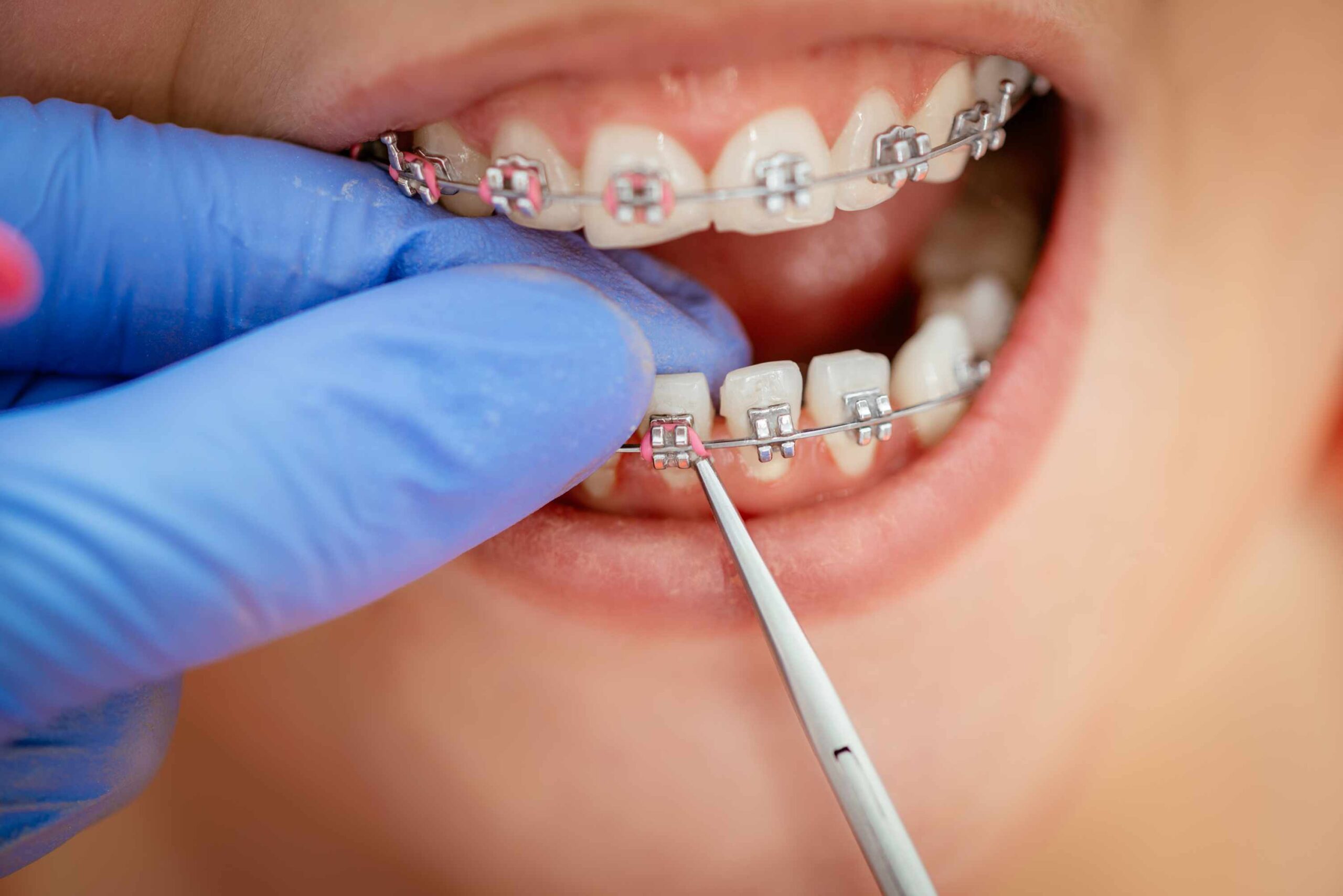 Orthodontist adjusting braces during teeth alignment treatment