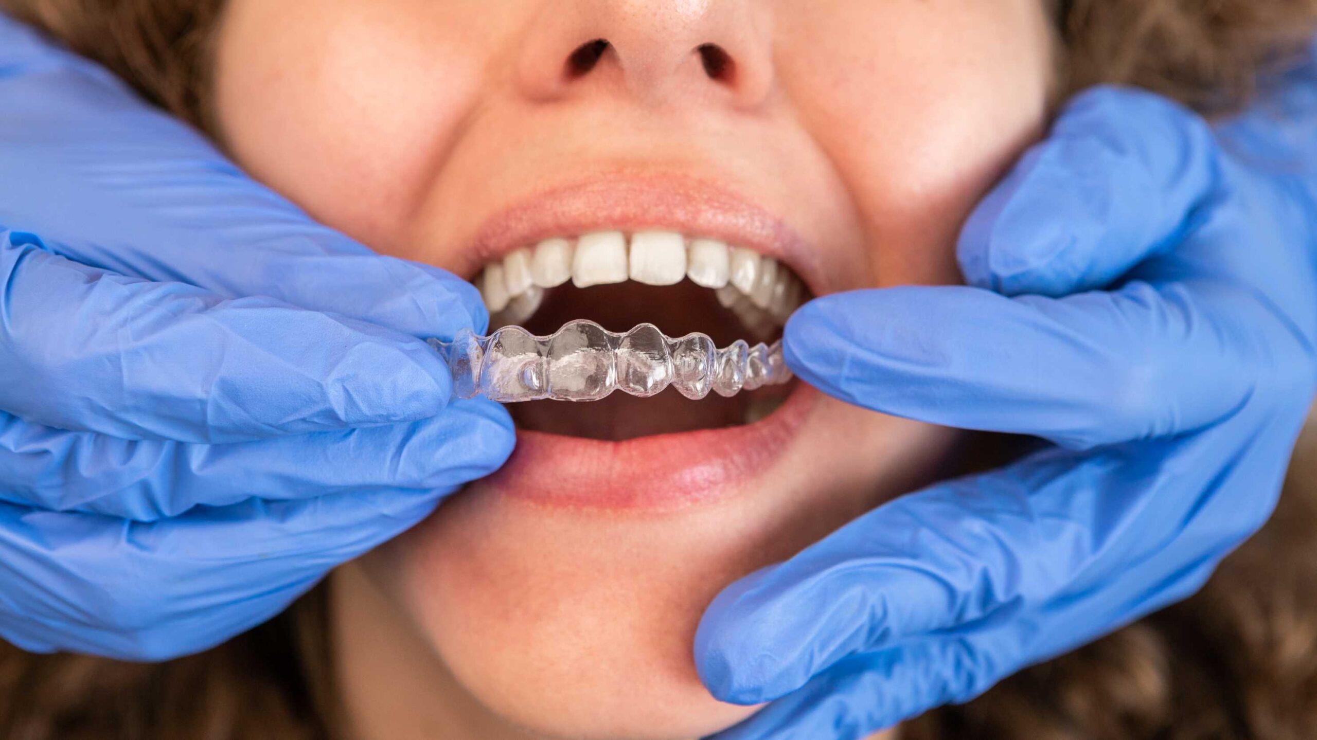 West Palm Beach orthodontist fitting a clear Invisalign aligner to help correct bite problems