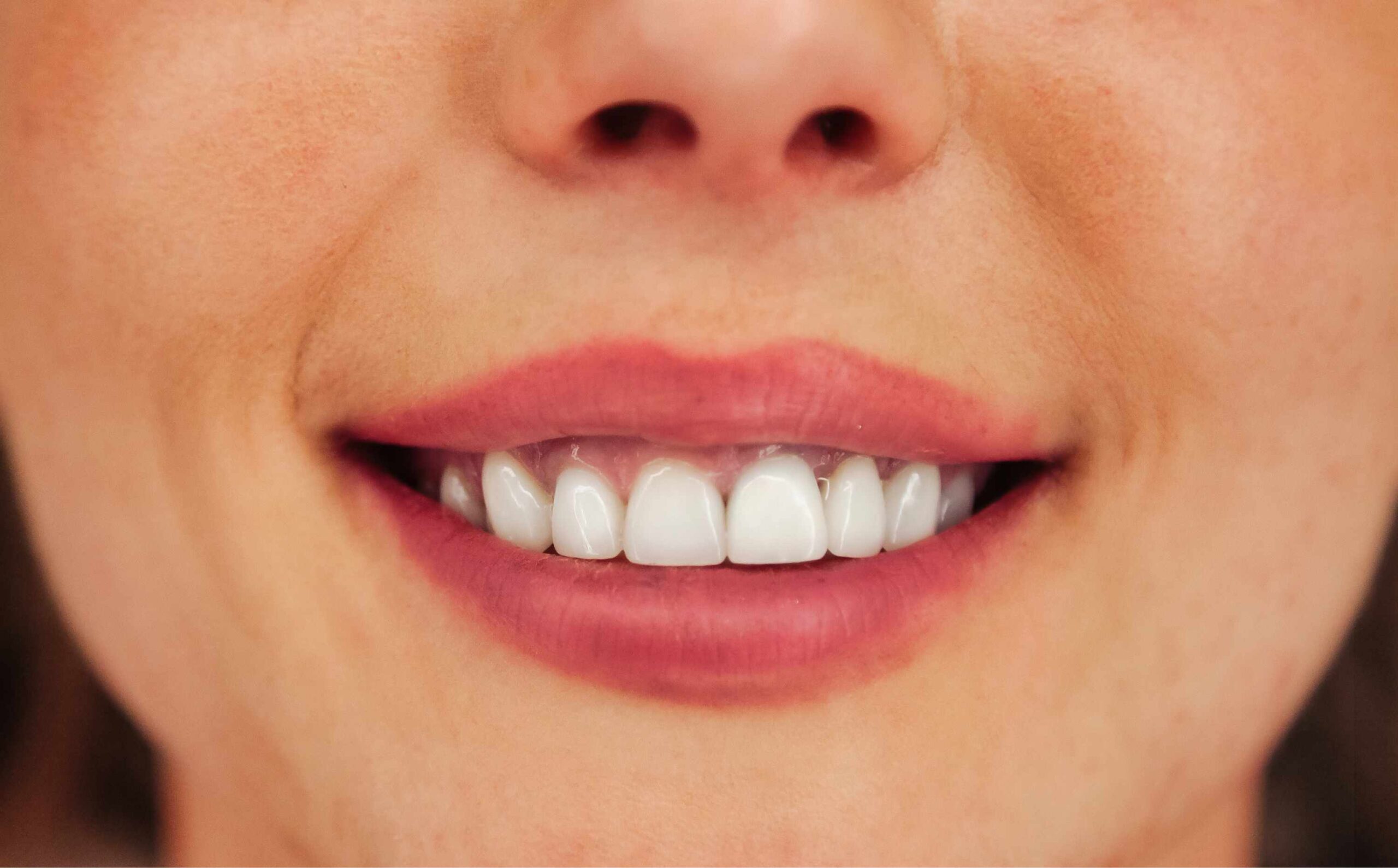 Close-up of a smiling woman showing upper teeth with visible black triangles between the teeth, illustrating possible gaps after Invisalign treatment.