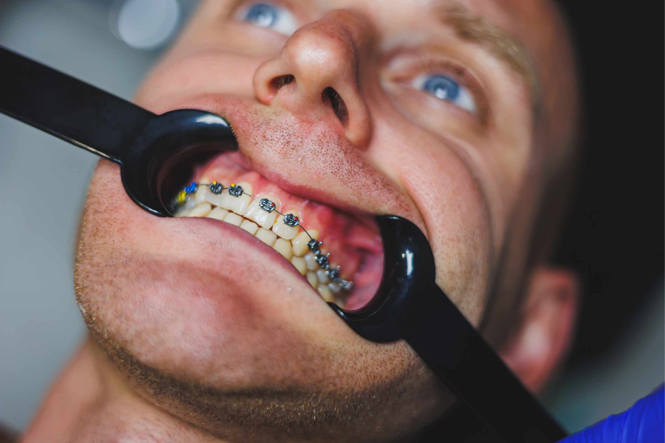Orthodontic patient receiving braces treatment, illustrating orthodontic approaches to widening the jaw compared with mewing and palatal expanders.