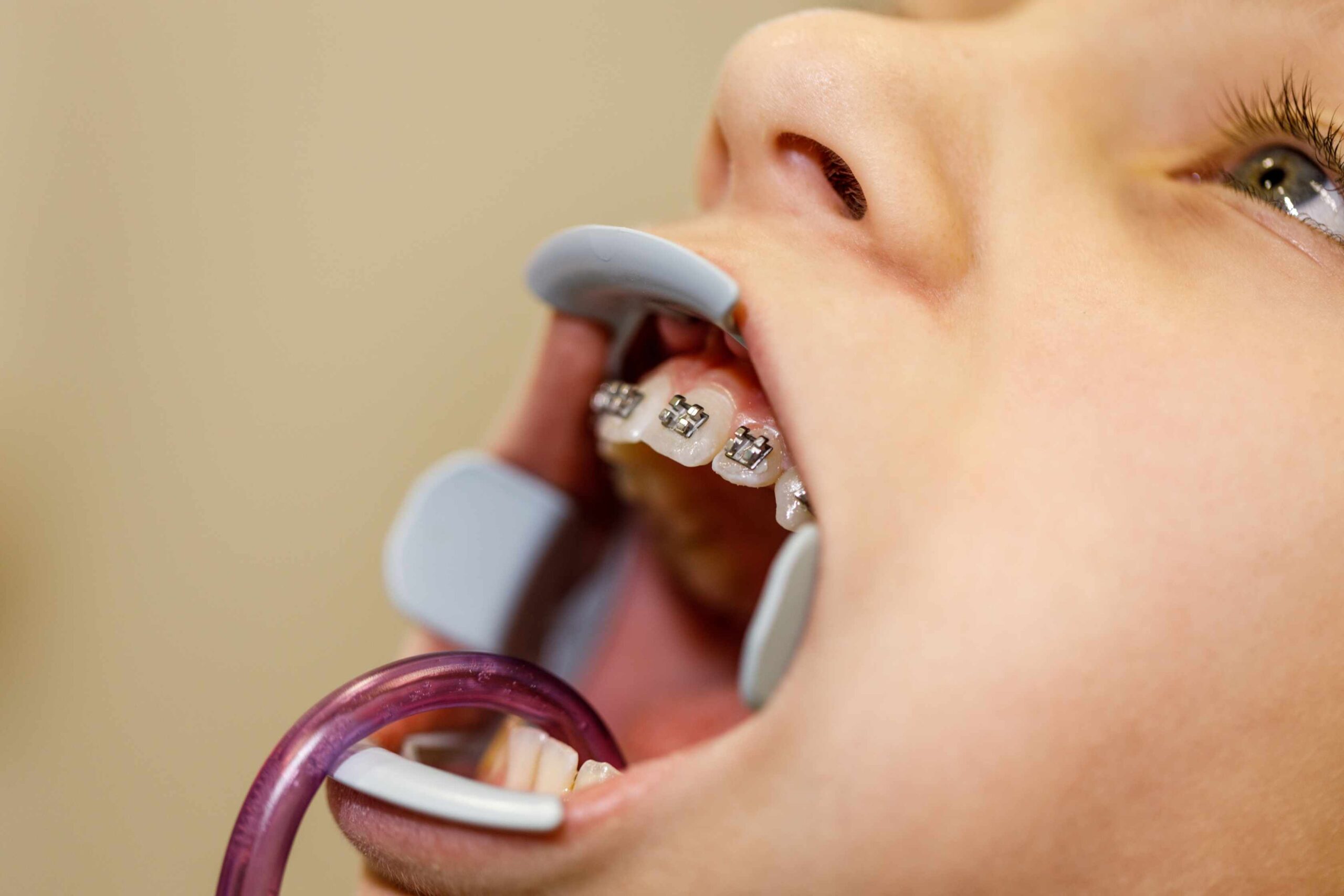 Child undergoing orthodontic treatment with braces and a dental cheek retractor during evaluation for palatal expansion and facial development